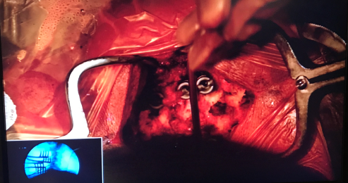 Live-Surgey-Cervical-Spine-1