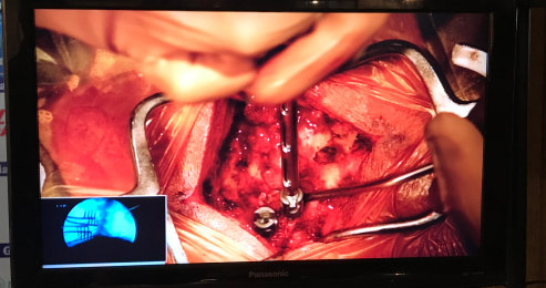Live-Surgey-Cervical-Spine-2