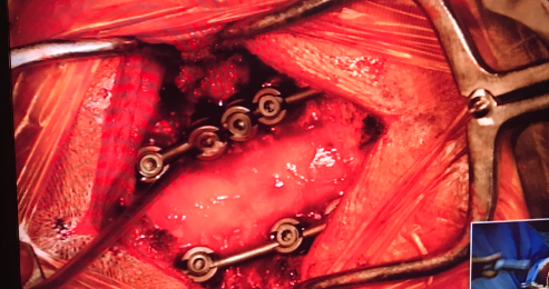 Live-Surgey-Cervical-Spine-3
