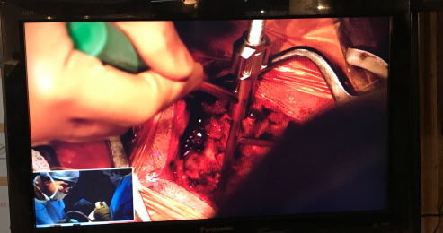 Live-Surgey-Cervical-Spine